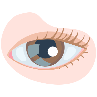 Глаукома — симптомы и лечение